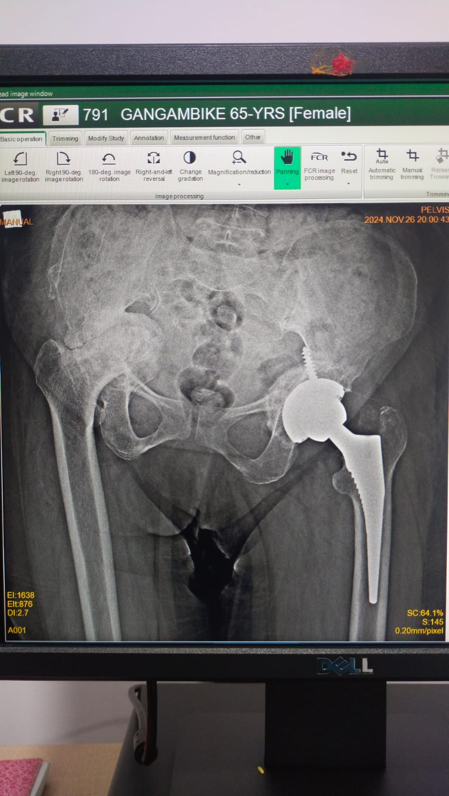 Before hip fracture fixation X-ray